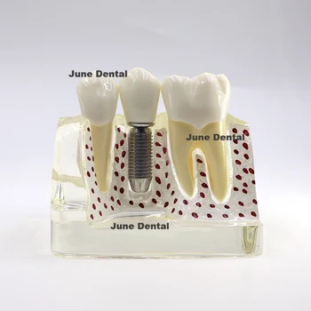 Демонстрация зубов Анализ Модели Съемных Зубов Имплантат Коронка Мостовидный Протез Исследование 2017